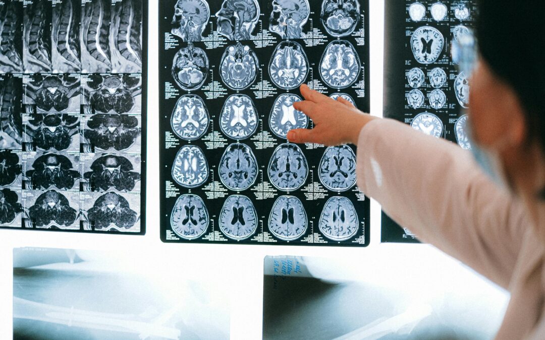 “Ultra-Fast” MRI could transform dementia diagnosis in Yorkshire