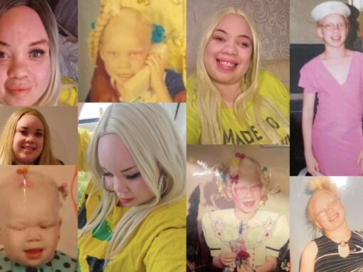 Albinism – paradox of colourism