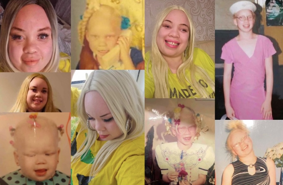 Albinism – paradox of colourism