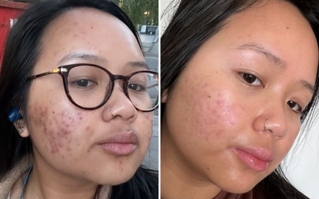 Dealing with acne in your 20s in the social media age