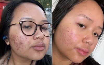 Dealing with acne in your 20s in the social media age