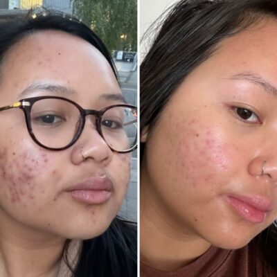 Dealing with acne in your 20s in the social media age