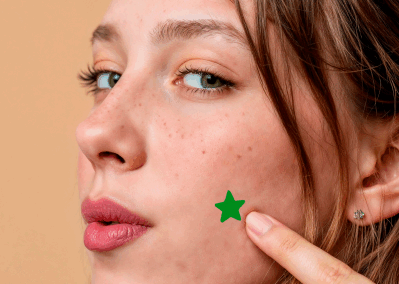  Stick On or Pass On: Do Pimple Patches Cure Acne or are they Just a Passing Trend?