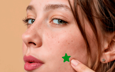 Stick On or Pass On: Do Pimple Patches Cure Acne or are they Just a Passing Trend?