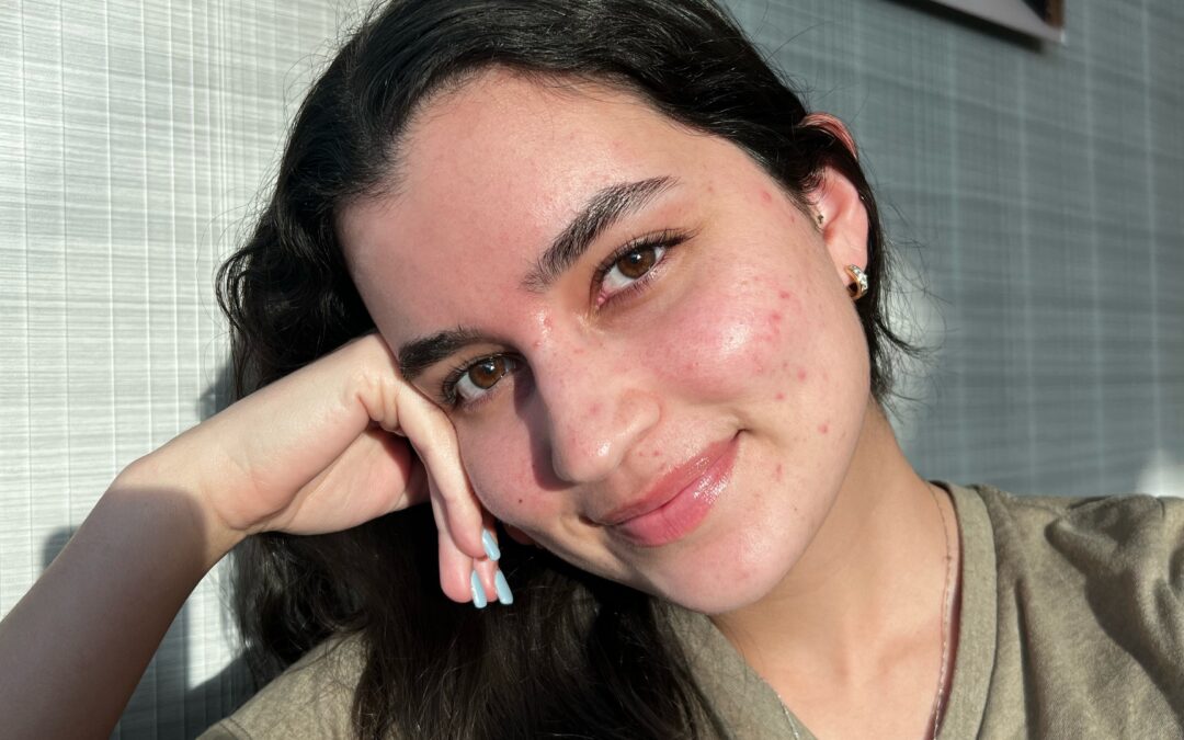 Let’s Talk About Acne, a Teenage Nightmare.