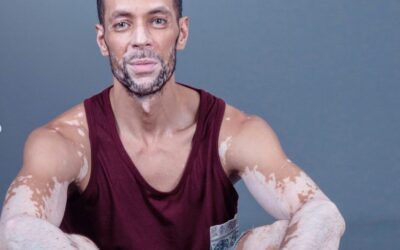 Embracing the colours of our skin: our journeys with vitiligo
