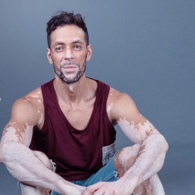 Embracing the colours of our skin: our journeys with vitiligo