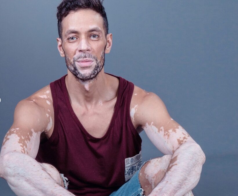 Embracing the colours of our skin: our journeys with vitiligo