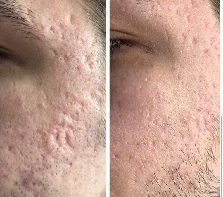 Acne Scars – What you need to know