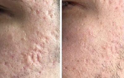 Acne Scars – What you need to know