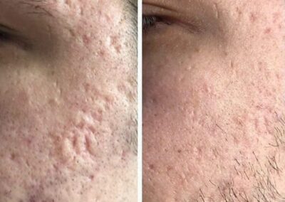 Acne Scars – What you need to know