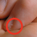 What are Hangnails? The pesky torn skin around your fingers