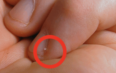 What are Hangnails? The pesky torn skin around your fingers