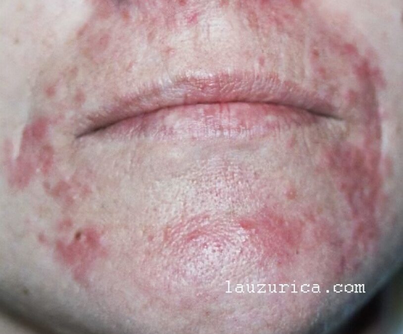 Perioral dermatitis; everything you need to know