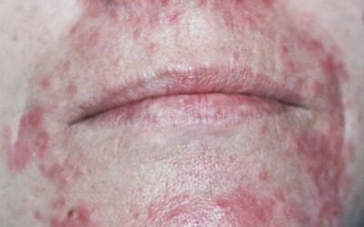 Perioral dermatitis; everything you need to know