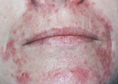 Perioral dermatitis; everything you need to know