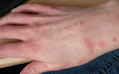 Scabies: Small Mites Big Trouble
