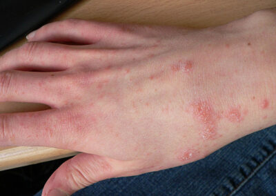 Scabies: Small Mites Big Trouble
