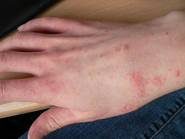 Scabies: Small Mites Big Trouble
