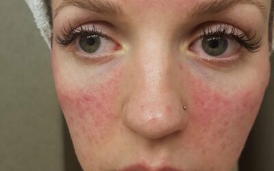 Rosacea: My Journey of Healing