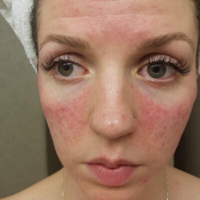 Rosacea: My Journey of Healing