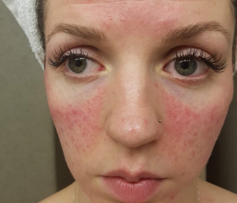 Rosacea: My Journey of Healing