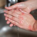 Eczema: one of the common skin conditions