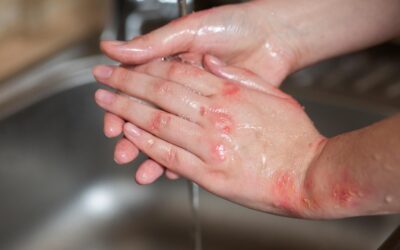 Eczema: one of the common skin conditions