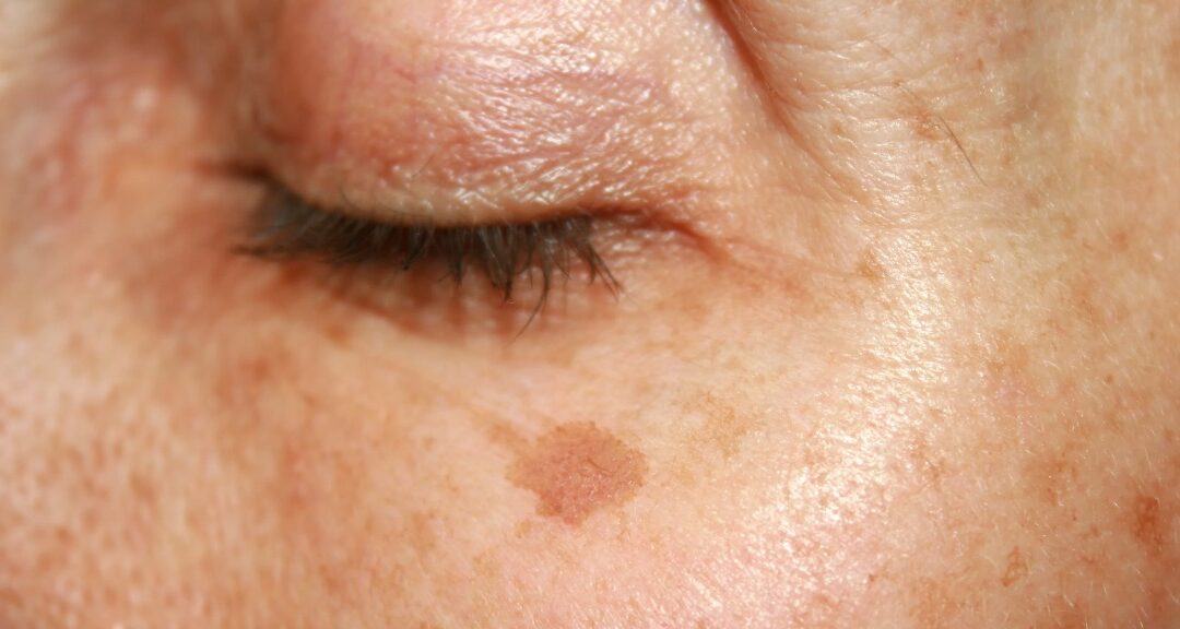 What’s that, is that HYPERPIGMENTATION?