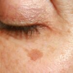 What’s that, is that HYPERPIGMENTATION?