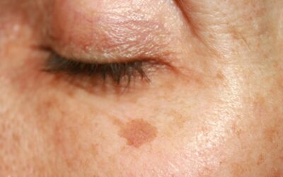 What’s that, is that HYPERPIGMENTATION?