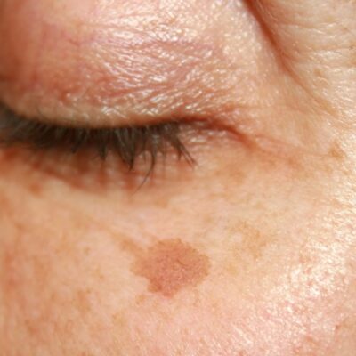 What’s that, is that HYPERPIGMENTATION?