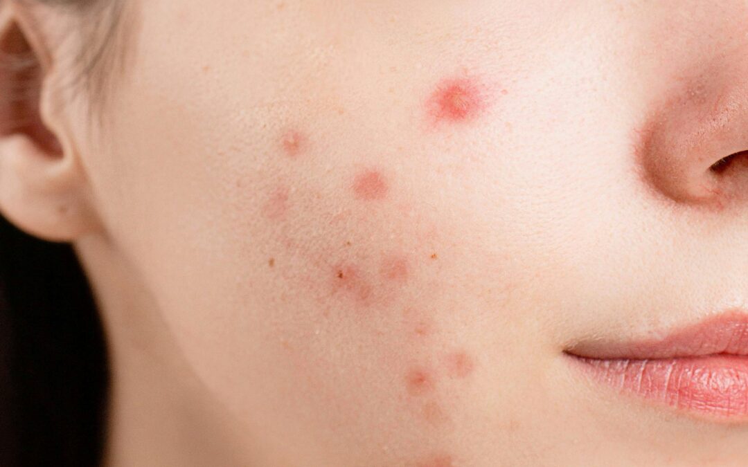 Is It Just a Phase? Understanding Acne Through the Ages