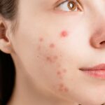 Is It Just a Phase? Understanding Acne Through the Ages