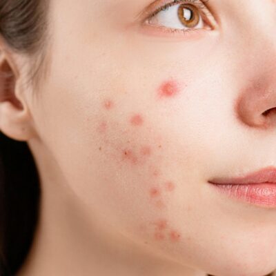 Is It Just a Phase? Understanding Acne Through the Ages