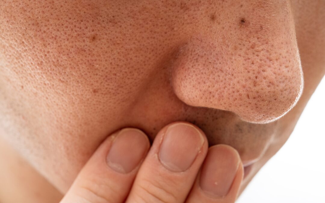 Pores: Can they be minimized?