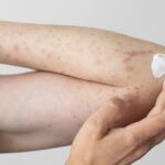 Skin Inflammation: the hidden causes behind many skin issues