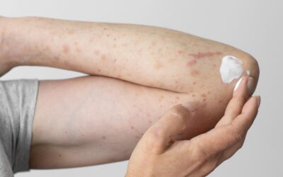 Skin Inflammation: the hidden causes behind many skin issues