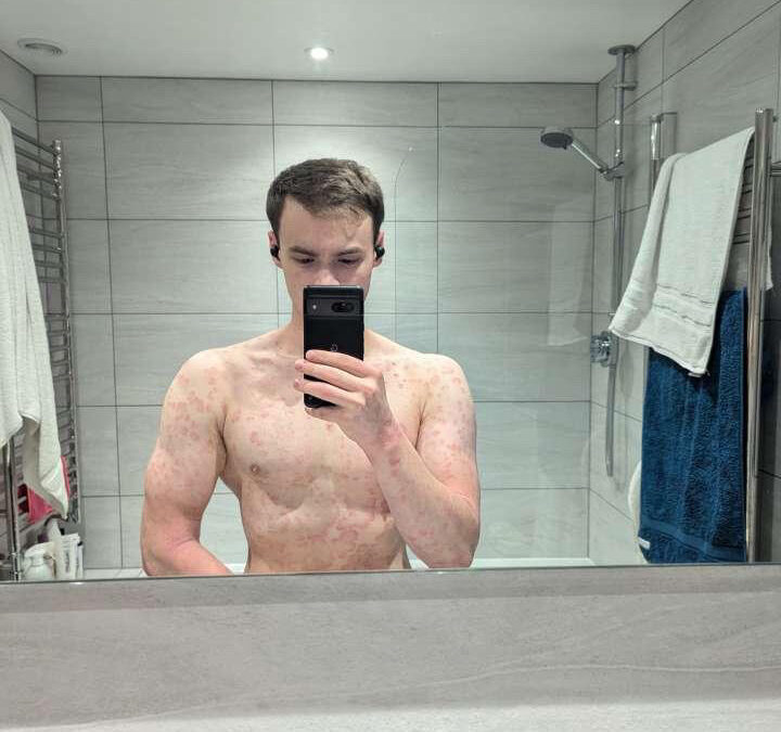 What it’s like to live with Psoriasis and Eczema