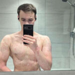 What it’s like to live with Psoriasis and Eczema