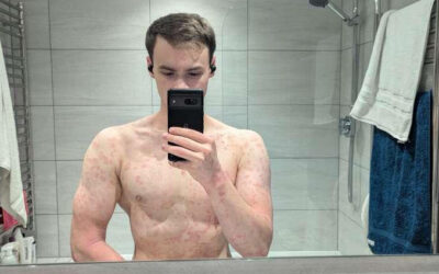 What it’s like to live with Psoriasis and Eczema