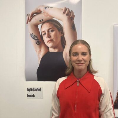 Flare ups? Flaky skin? We don’t mind – #GetYourSkinOut