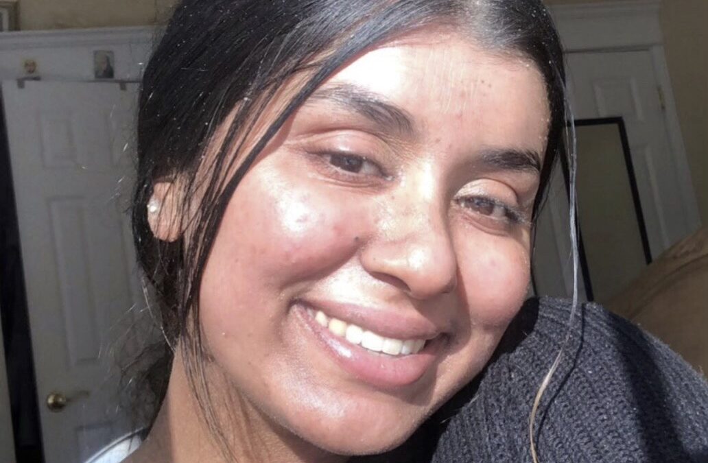 ‘My rare skin condition helped me find purpose’: Eileen’s Ichthyosis Story